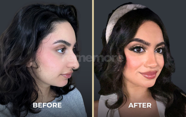 Rhinoplasty before and after